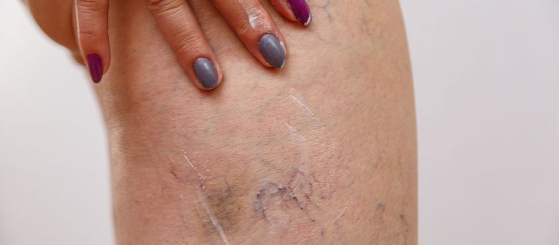 An elderly woman smears a cream or ointment on her leg on a light isolated background. A concept for medicine and cosmetology.